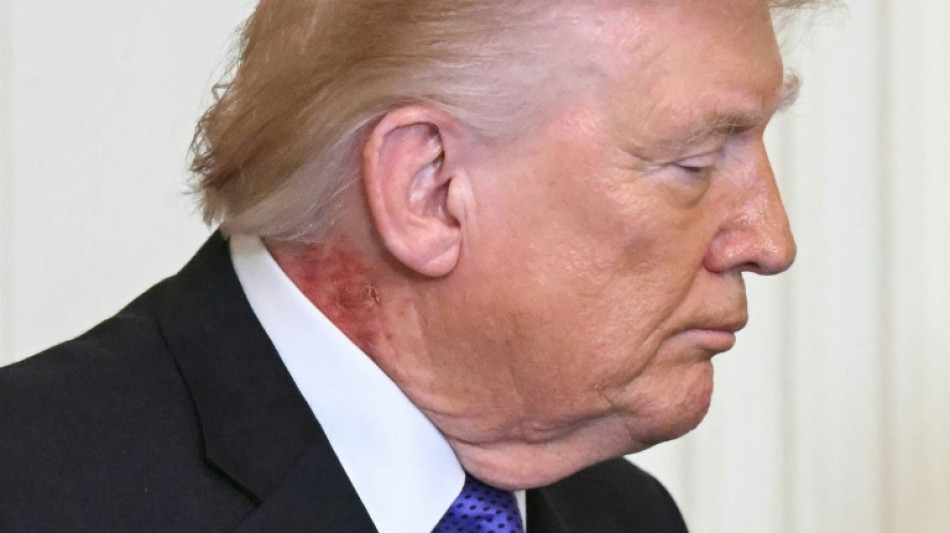 Trump vu avec une grande plaque rouge&acirc;tre dans le cou