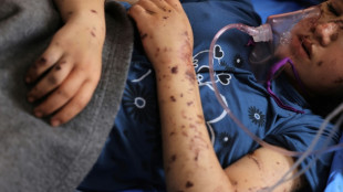 "&iexcl;Devu&eacute;lvanme mis piernas!": el grito de ni&ntilde;os amputados en la guerra de Gaza